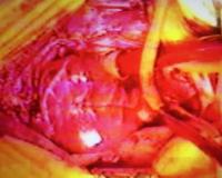 Imagen 1 del trasplante realizado por el doctor Javier Cabo  